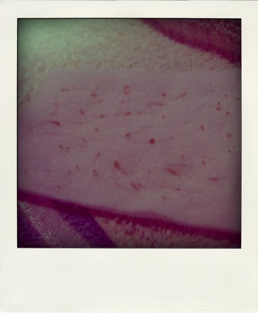 100 ♥Mar.07 中指(終止)傷痛。