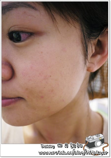 使用「DePas水凝凍膜」，過敏肌掰掰～