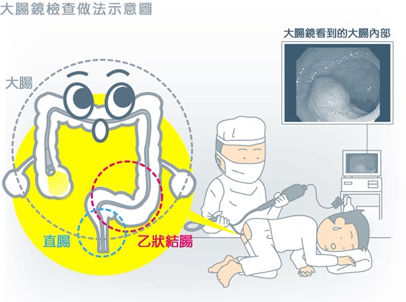 大腸鏡
