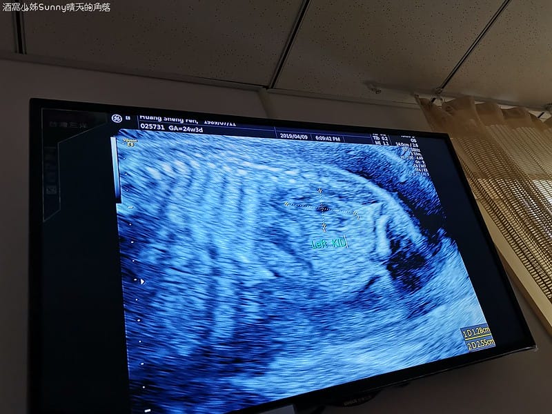 嘉義產檢x嘉安婦幼診所x4D高層次超音波檢查