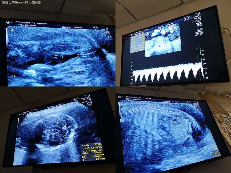 嘉義產檢x嘉安婦幼診所x4D高層次超音波檢查