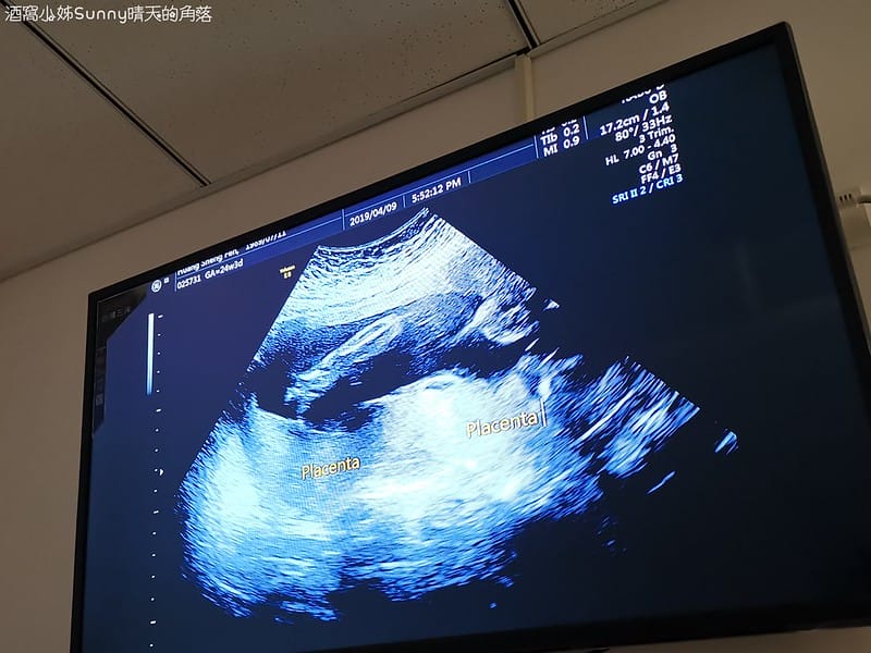 嘉義產檢x嘉安婦幼診所x4D高層次超音波檢查